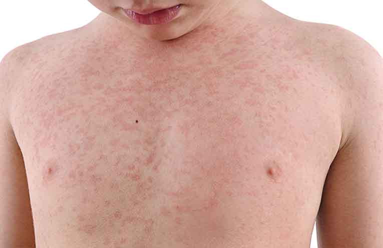 Measles is about – check that your immunisations are up to date
